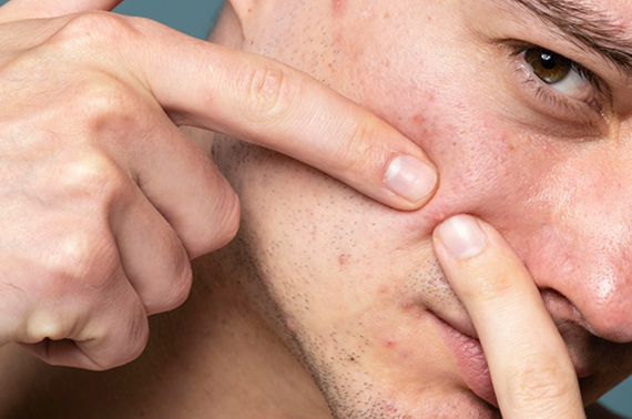Skin Breakouts